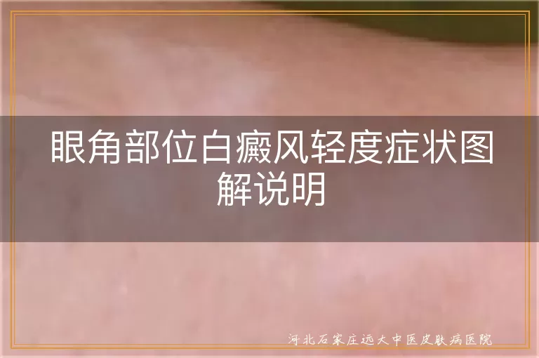 眼角部位白癜风轻度症状图解说明