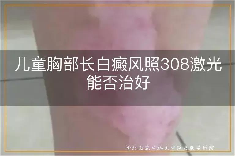 儿童白癜风治疗效果,308激光治疗白斑,白癜风能否治愈,儿童白斑治疗建议