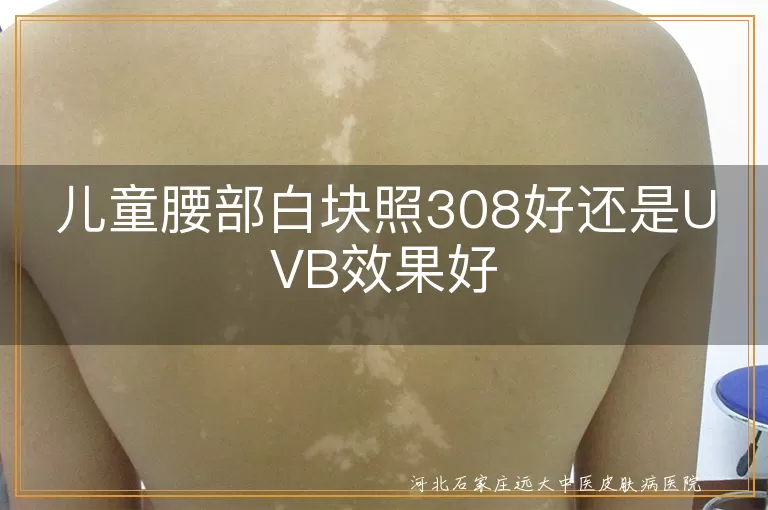 儿童腰部白块照308与UVB对比, 白癜风治疗选择, 白斑光疗效果, 儿童白斑治疗