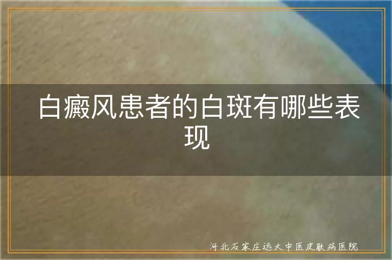 白癜风白斑颜色,白癜风白斑形状大小,白癜风白斑分布位置,白癜风白斑发展变化
