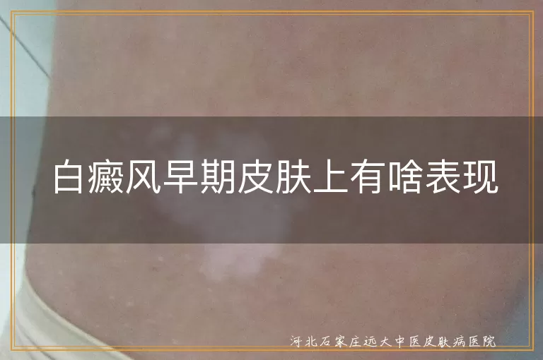 白癜风早期白斑表现,白斑边缘特征,白斑扩大趋势,白斑处皮肤敏感