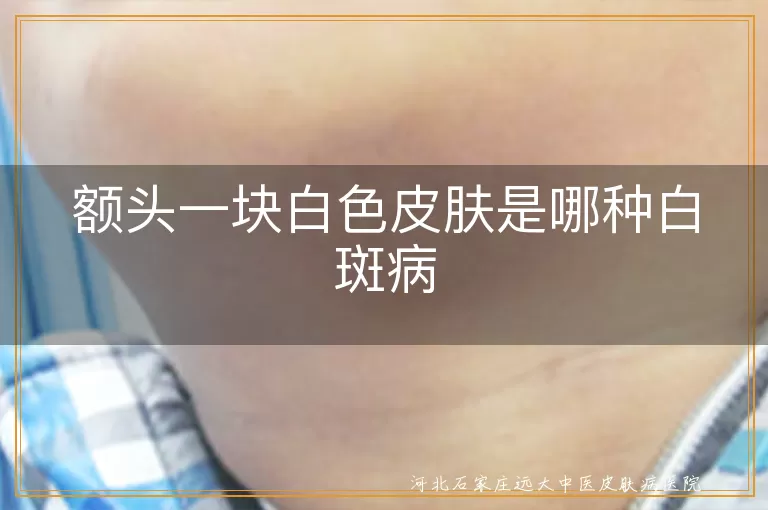 额头白斑病种类,白癜风症状与治疗,白斑病日常护理,额头白斑病原因