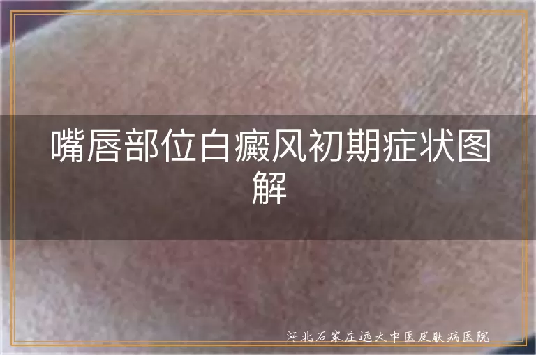 嘴唇部位白癜风初期症状图解