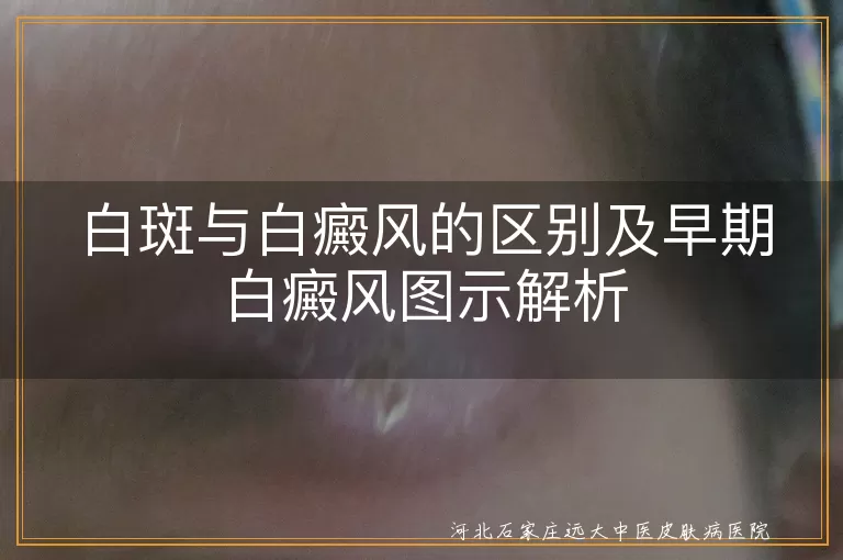 白斑与白癜风差异,早期白癜风症状图,白癜风白斑特点,识别白癜风方法