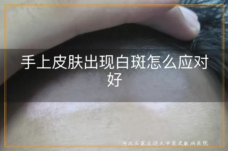 手上白癜风如何应对,白斑科学治疗方法,生活调理预防白斑,白癜风心理调适技巧