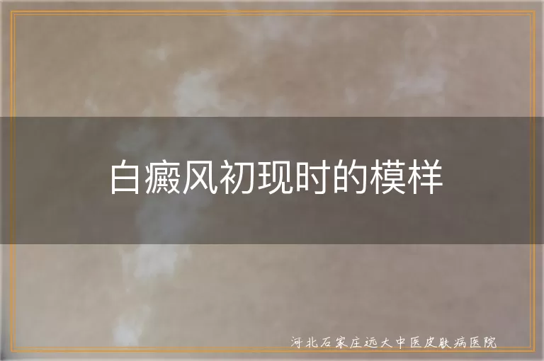 白癜风初现时的模样