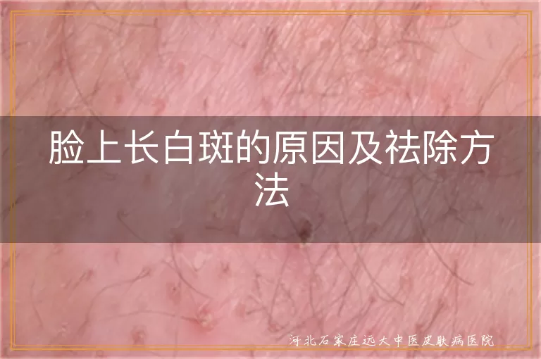 脸上长白斑的原因,白斑祛除方法,白癜风治疗,白斑日常护理