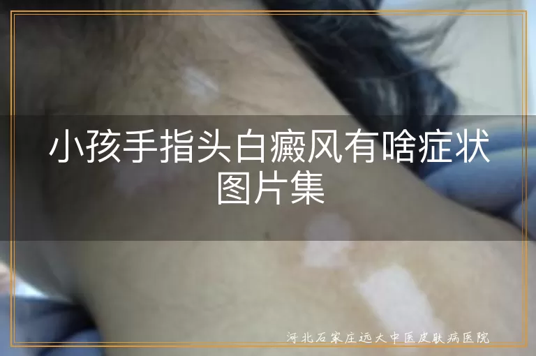 小孩手指头白癜风症状,白斑扩散特点,白斑颜色变化,儿童白癜风初期表现