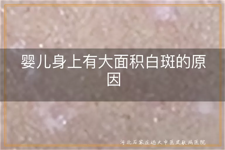 婴儿白斑病原因,婴儿身上白斑与白癜风,婴儿白斑病治疗,婴儿身上白斑病因分析