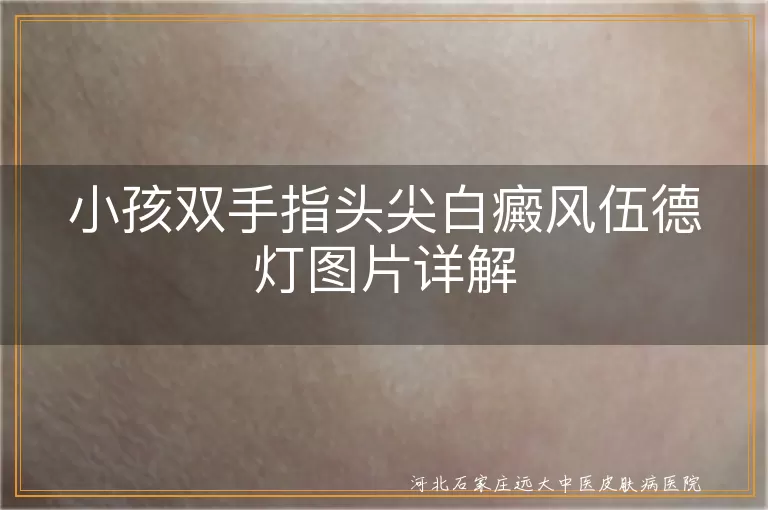 小孩双手指头尖白癜风伍德灯表现,儿童白癜风伍德灯诊断,白斑伍德灯下特征,白癜风伍德灯检查方法