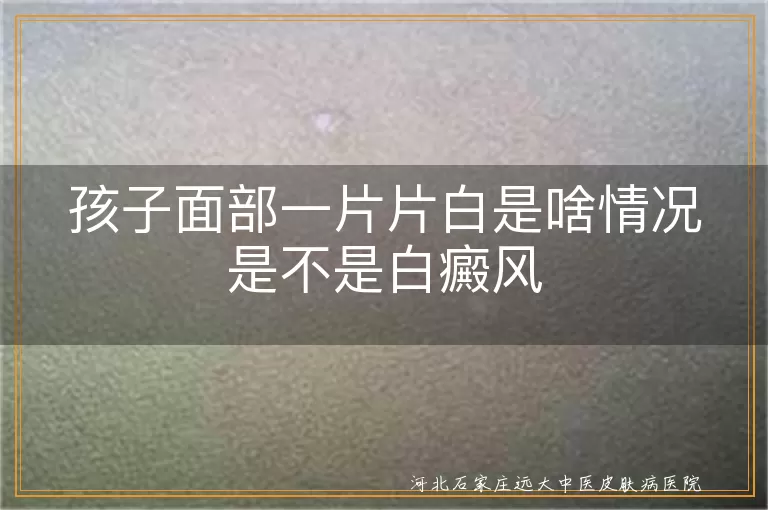 孩子面部白斑原因,白癜风症状特点,白癜风治疗方法,儿童白癜风护理