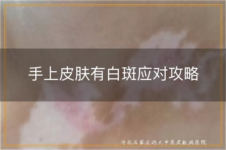 手上白癜风治疗方法,白斑日常护理建议,白癜风饮食调整,白斑心情调节