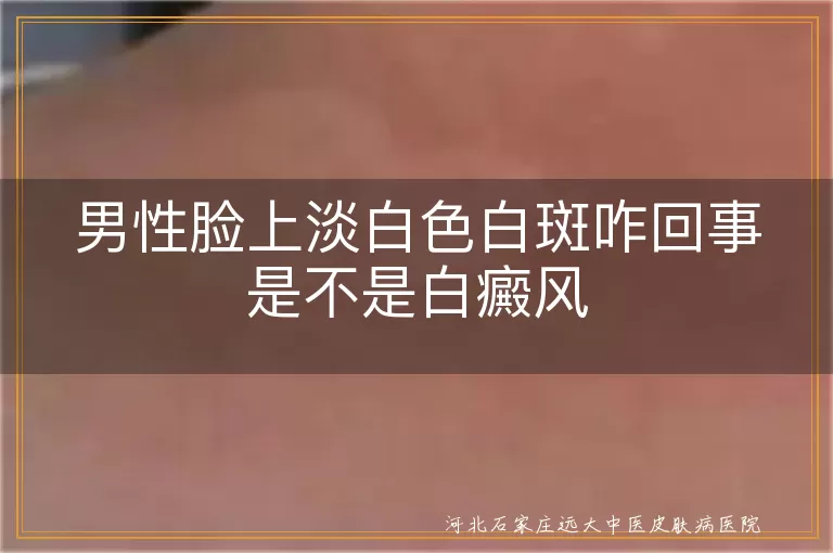 男性脸部白斑原因,白癜风症状特点,白斑与白癜风区别,如何预防白癜风