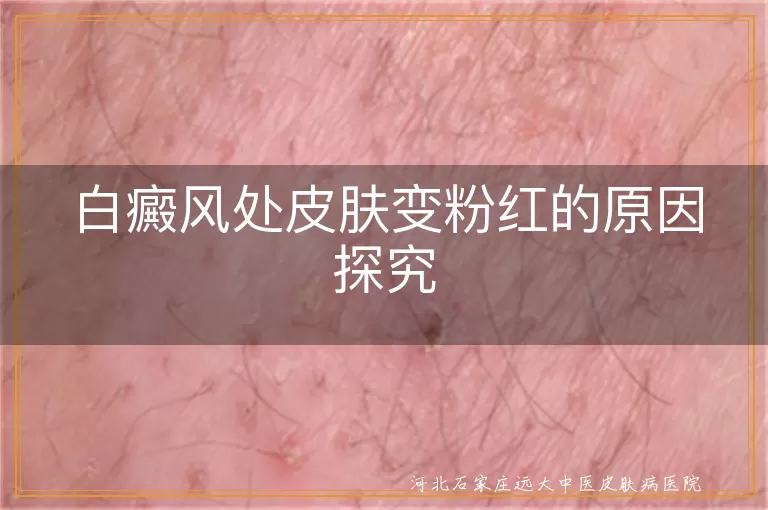 白癜风皮肤变粉红原因,白斑处皮肤变色,白癜风病情好转迹象,白癜风治疗与护理