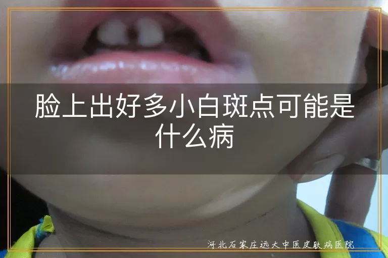 脸上小白斑点可能是什么病, 白斑病因分析, 白癜风症状与治疗, 白斑预防方法