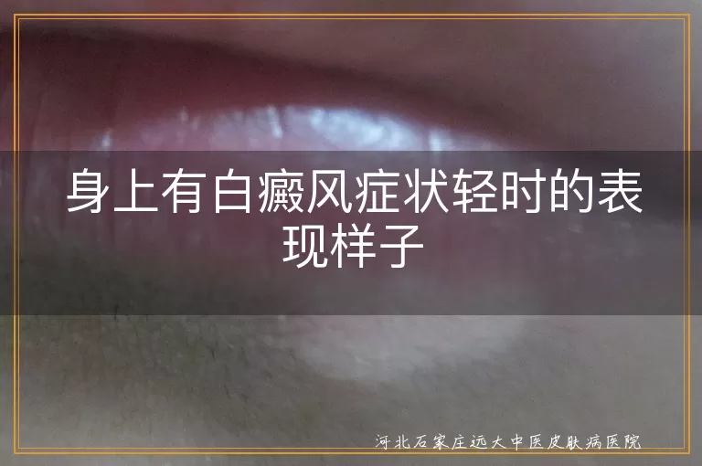 白癜风轻微症状,白斑初期表现,白癜风早期信号,白斑边缘模糊特征