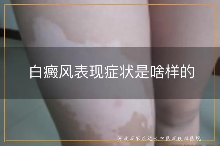 白癜风白斑表现,白癜风扩散症状,白癜风伴随症状,白癜风患者体验
