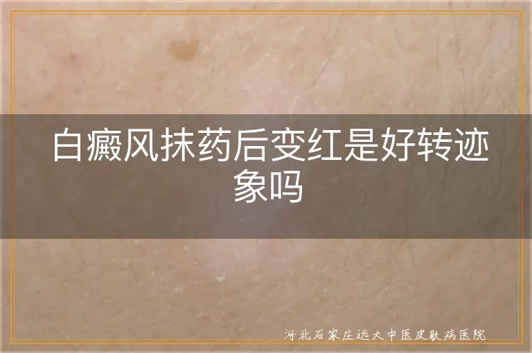 白癜风抹药变红,白癜风病情好转迹象,白癜风治疗判断,白斑变化观察