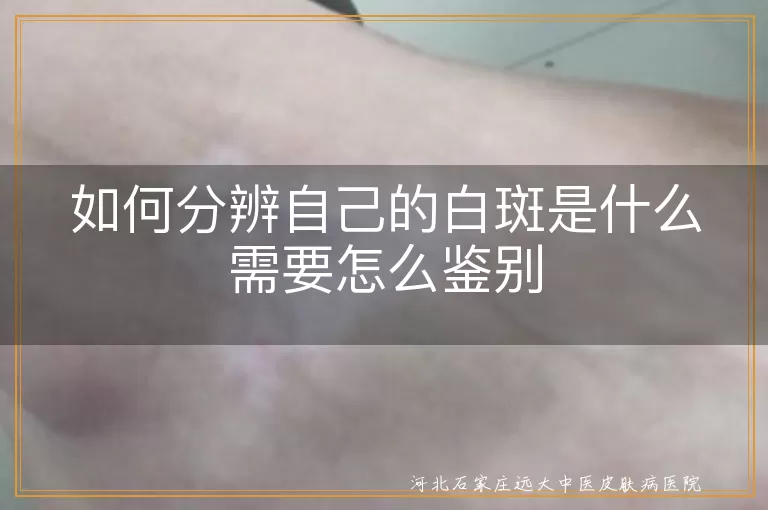 白癜风鉴别方法,白斑类型特征,专业医生诊断,伍德灯检查