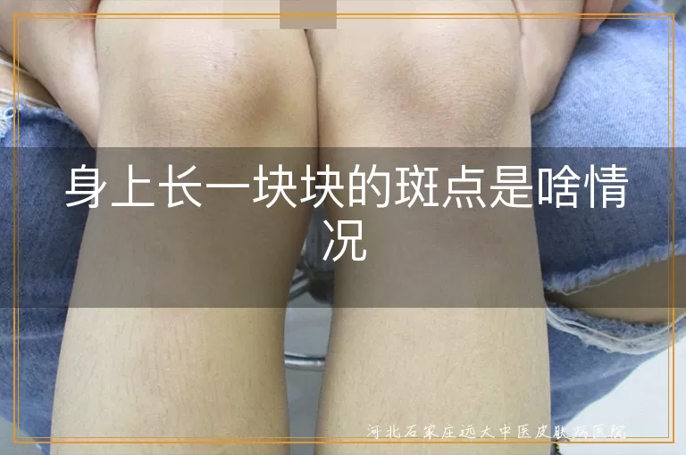 白癜风症状表现,白斑病治疗方法,身上长白斑是白癜风吗,皮肤白斑病如何确诊