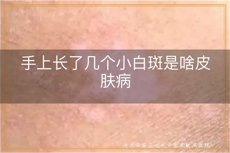 手上白癜风症状,白斑可能是哪些皮肤病,无色素痣与白癜风区别,白色糠疹白斑特点
