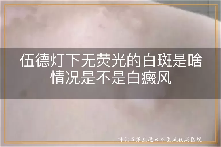 伍德灯无荧光白斑原因,白斑是否白癜风,无荧光白斑可能病症,白癜风诊断方法