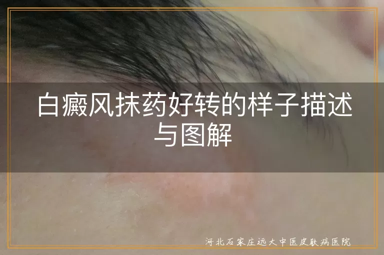 白癜风抹药好转迹象,白斑颜色变化过程,白癜风治疗效果图,白斑逐渐消失描述