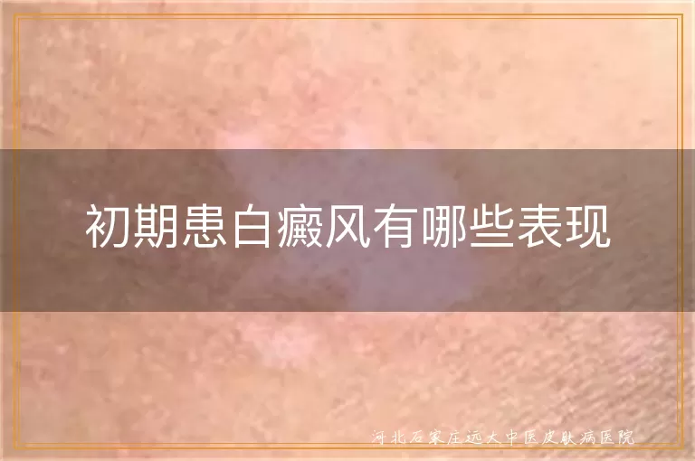 白癜风初期症状,白斑边缘清晰,白斑对日光敏感,白癜风伴随症状