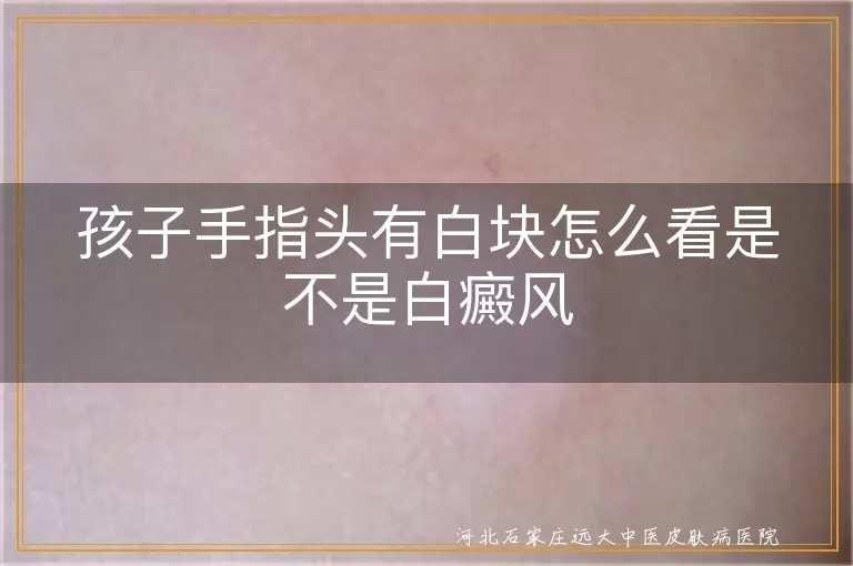 孩子手指头白块判断白癜风, 白斑与白癜风区别, 手指白块症状分析, 白癜风诊断方法
