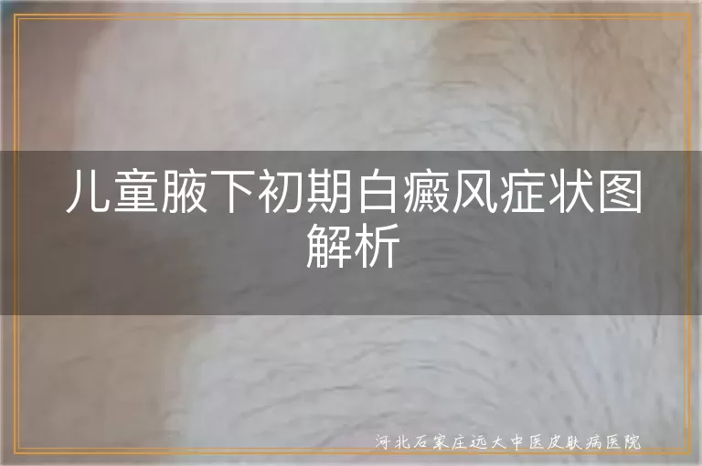 儿童腋下白癜风症状图, 白癜风白斑特征, 儿童白癜风初期识别, 腋下白斑护理
