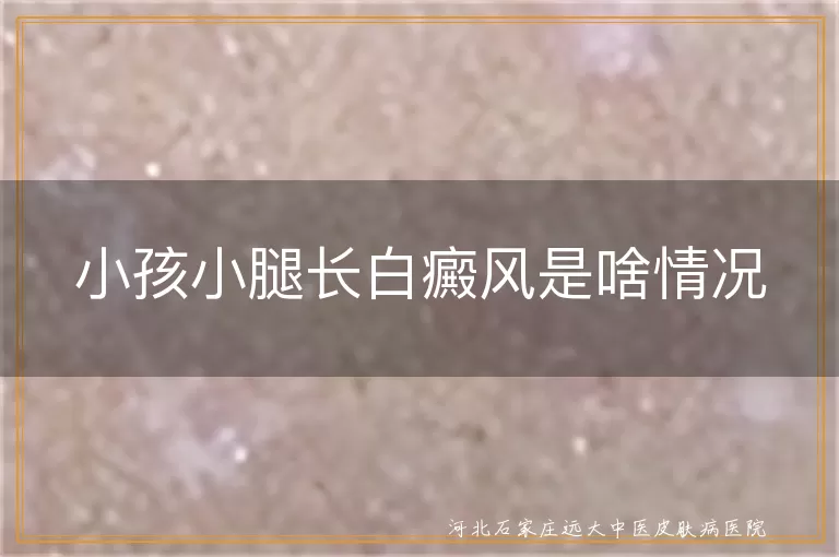 小孩小腿白癜风原因,儿童白癜风治疗方法,白癜风生活护理建议,白癜风能否治愈
