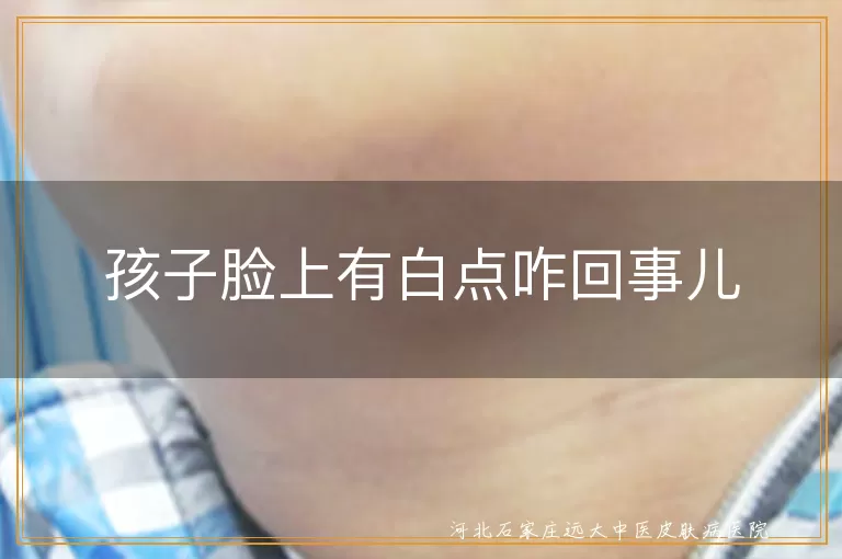 孩子面部白斑原因,白癜风初期症状,儿童白斑病种类,无色素痣与白癜风区别