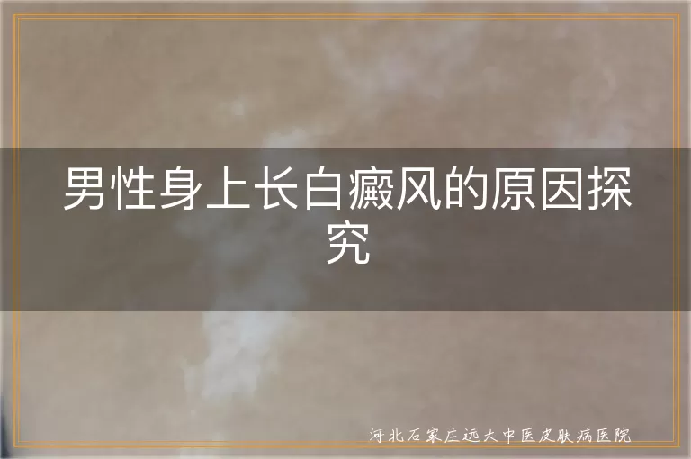 男性白癜风原因,白癜风遗传因素,白癜风与免疫力,生活习惯与白癜风