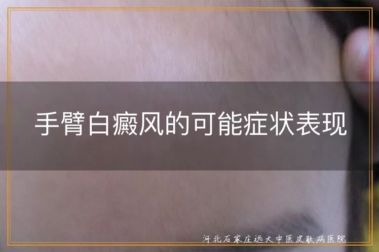 手臂白斑症状,白癜风早期表现,白斑扩散特点,白癜风皮肤异常