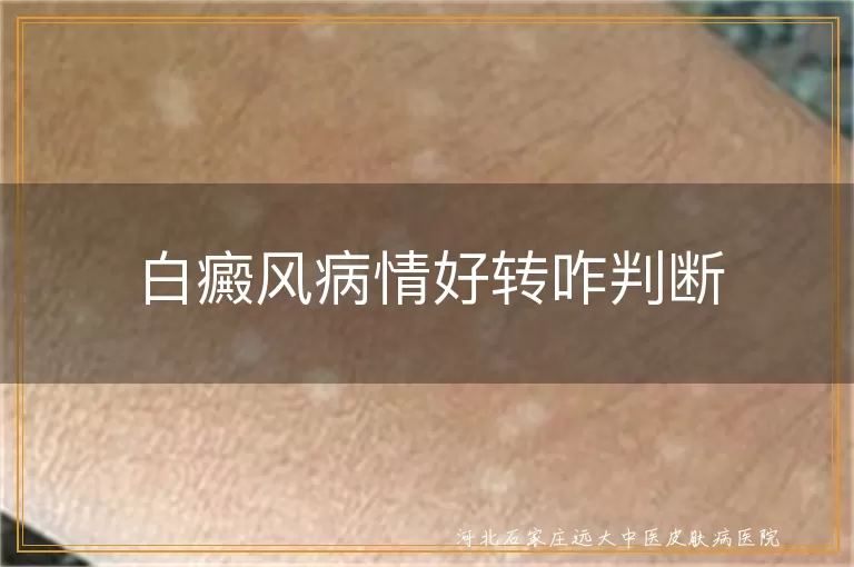 白癜风白斑颜色变淡,白癜风白斑边缘模糊,白癜风白斑面积缩小,白癜风皮肤感觉恢复