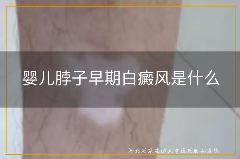 婴儿脖子白癜风症状,婴儿白斑早期症状,婴儿白癜风预防,婴儿白癜风治疗