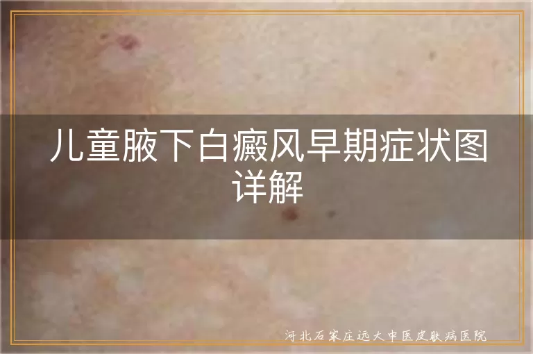 儿童腋下白癜风症状,白癜风早期表现,白斑识别方法,儿童白斑初期图