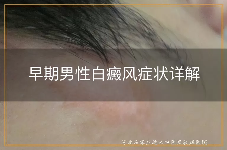 早期男性白癜风症状详解