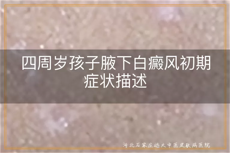 四周岁孩子腋下白癜风初期症状,儿童白癜风白斑表现,幼儿白癜风初期图案,白癜风初期识别与护理