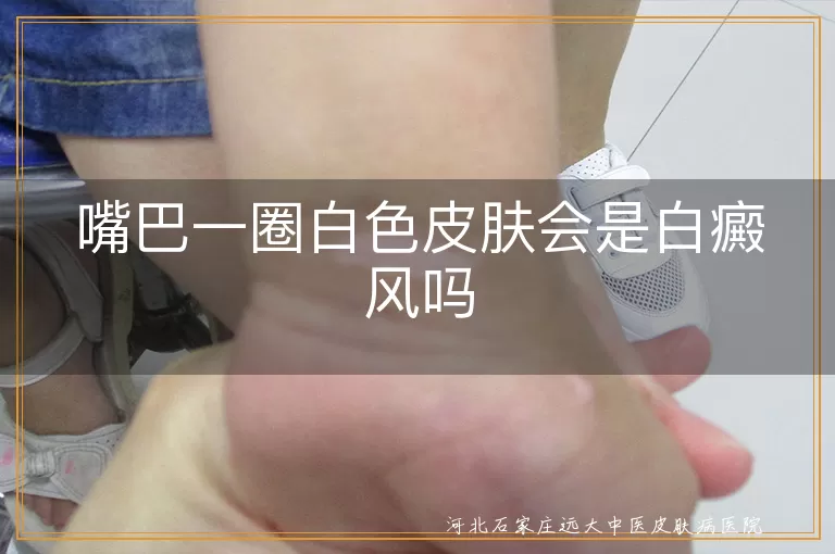 嘴巴周围白斑原因,白癜风症状判断,白斑与白癜风区别,皮肤白斑确诊方法