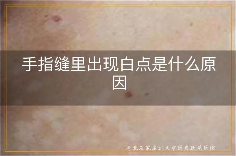 手指缝里白点与白癜风关系,手指缝白斑原因探究,手指缝白点警惕白癜风,手指缝白斑识别与应对