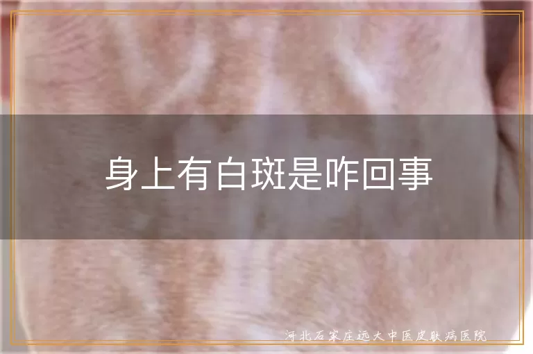 白癜风症状,白斑原因解析,白斑预防方法,白斑治疗方法