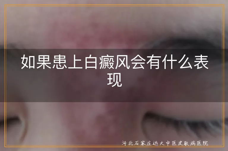 白癜风皮肤白斑症状,白癜风感觉异常表现,白癜风对光敏感特点,白癜风可能引发的问题