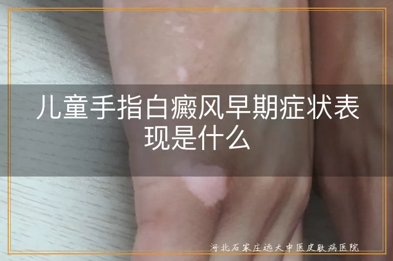 儿童手指白癜风早期症状,手指白斑早期表现,白癜风儿童早期症状,手指白癜风早期识别