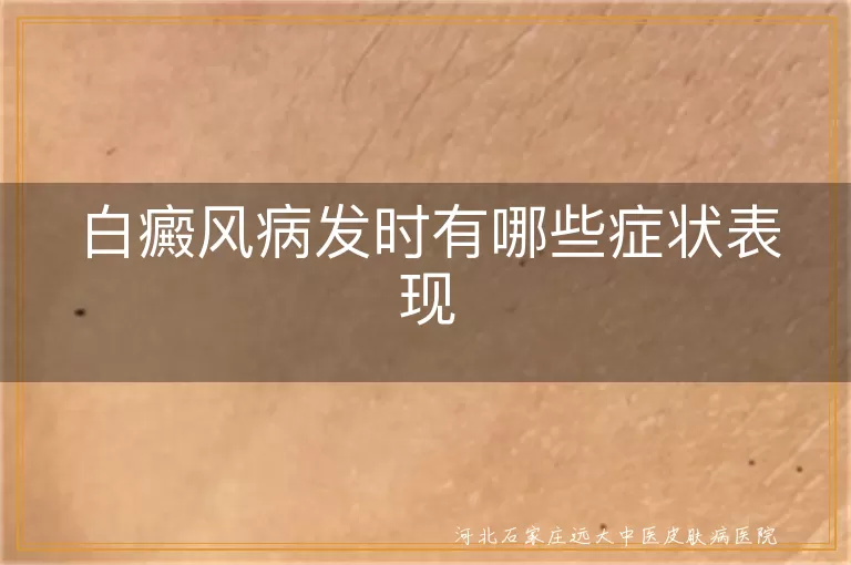 白癜风白斑表现,白斑扩散症状,白癜风皮肤敏感,白癜风心理压力