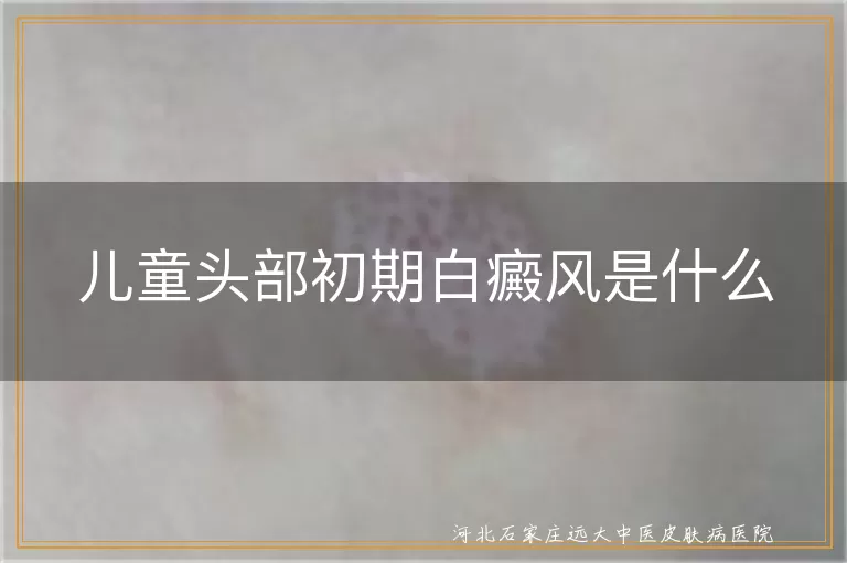儿童头部白癜风症状,初期白斑特征,白癜风护理要点,白斑发展原因