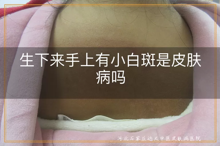 新生儿白斑是白癜风吗,手上小白斑皮肤病症状,白癜风与无色素痣区别,宝宝白斑护理方法