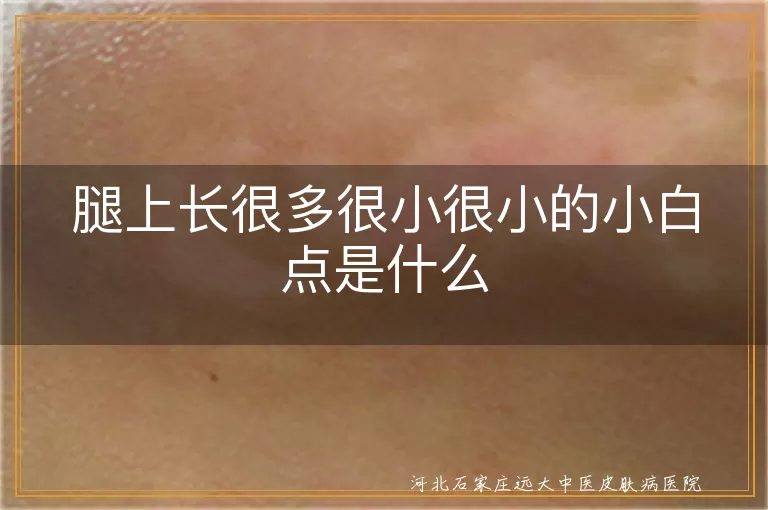 腿上小白点可能是白癜风, 白斑原因解析, 小白点对症治疗, 白斑预防方法