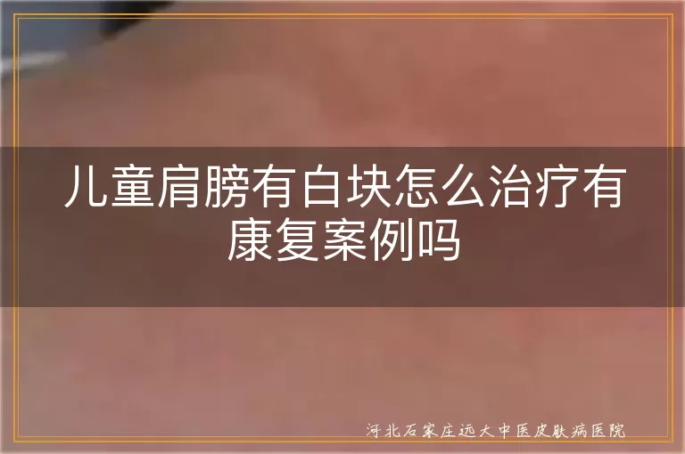 儿童肩膀白块治疗,白癜风康复案例,白斑治疗方法,儿童皮肤病治疗