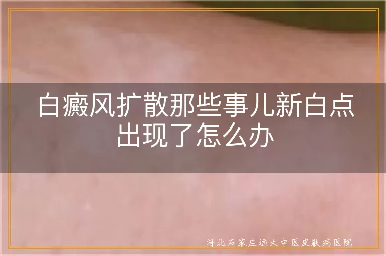 白癜风新白点应对方法,白斑扩散原因解析,白癜风预防小妙招,白斑治疗注意事项